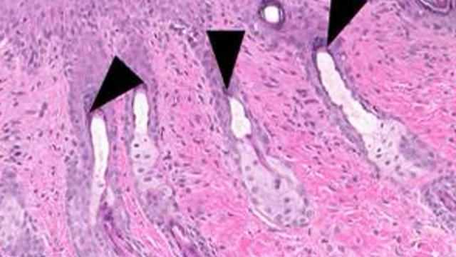 Parasitic worms 